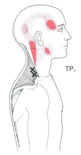 Trapezius The Trigger Point Referred Pain Guide