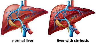 Cirrhosis of the liver pictures. Managing And Treating Cirrhosis