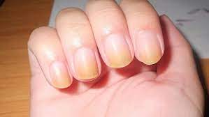 Oleh karena itu, kamu perlu memeriksakan diri ke dokter jika mengalami kondisi ini. Kuku Kuning Tak Boleh Disepelekan Merahputih