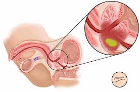 Image result for Expressed Prostatic Secretion