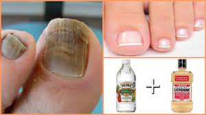 Maybe you would like to learn more about one of these? Elimina Los Hongos De Las Unas De Los Pies Con Este Remedio Youtube