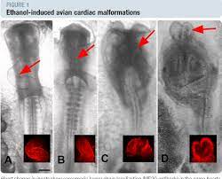 Fetal Alcohol Syndrome Cardiac Birth Defects In Mice And Prevention With Folate Semantic Scholar