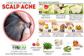 Scalp Acne Medical Treatment Home Remedies Self Care Scalp Acne Natural Acne Remedies Pimples On Scalp