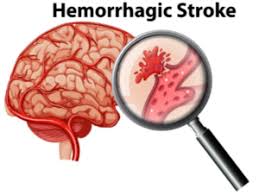 A ruptured aneurysm can cause serious health problems such as hemorrhagic stroke, brain damage, coma, and even death. Brain Aneurysm Surviving A Rupture With Fast Treatment Scary Symptoms