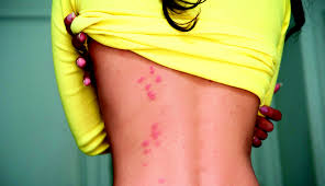 Image result for spinne biss haut reaktion