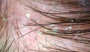 Image result for dry scabs on the head in children