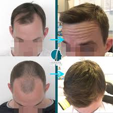 What is a hair graft. Grade 3 Grade 3 Vertex Grade 4 Hair Loss Maral Hair