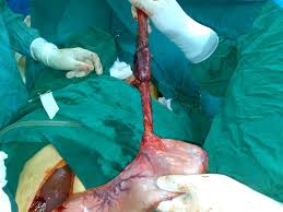 Mckeown graduated from the medical university of south carolina college of medicine in 2010. Esophagectomy Wikipedia