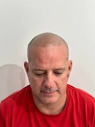 ✨ Confidence Restored ✨ Scalp Micropigmentation (SMP) is a non-surgical  solution that creates the look of a fuller, thicker head of hair. Whether  you're covering thinning areas, scars, or a receding hairline –