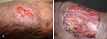 Mucormycosis (previously called zygomycosis) is a serious but rare fungal infection caused by a group of molds called mucormycetes. Mucor Irregularis Associated Cutaneous Mucormycosis Case Report And Review Sciencedirect