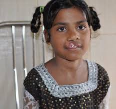 Rotaplast Missions: 2011 Chittagong, Bangladesh