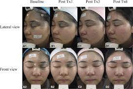 Comparison Of A Picosecond Alexandrite Laser Versus A Q Switched Alexandrite Laser For The Treatment Of Nevus Of Ota A Randomized Split Lesion Controlled Trial Journal Of The American Academy Of Dermatology