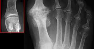 Pin On Arthritis Feet Hands Etc