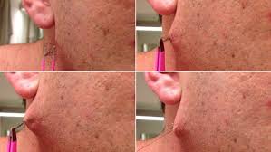 The kit includes a body brush, a facial brush, and a pair of tweezers for spot treatments. Moment Man Pulls World S Longest Ingrown Hair From His Face Daily Mail Online