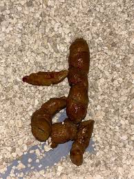 Image result for blood in stool human poop