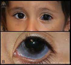 Image result for nevus sclerae
