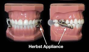 Officially got my braces off yesterday and i'm insanely happy with the end results. Functional Appliances To Correct Bite Problems Plaza Orthodontics Ballwin Missouri
