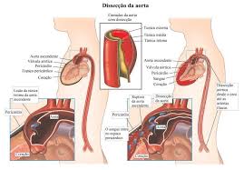 Apenas o médico pode determinar qual o. Aneurisma Da Aorta Abdominal Sintomas E Cirurgia