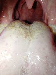 Bei soorösophagitis häufig retrosternales brennen, dysphagie, übelkeit. Ist Das Mundsoor Oder Nicht Gesundheit Medizin