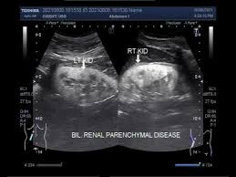Homeopathic Treatment For Chronic Kidney Diseases In Homeopathy, Chronic  Kidney Diseases Treatment In Patna & Ranchi