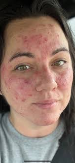 Rowe Casa products help with acne