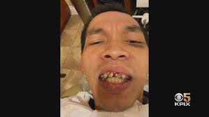 UPS Driver Requires Dental Surgery After Getting Robbed, Beaten In SF