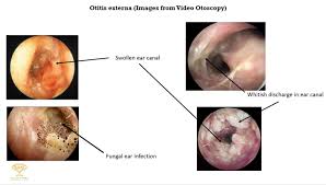 Image result for Acute Otitis Externa