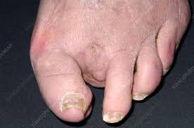 Image result for toe amputation