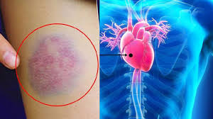 दिल में छेद होना खतरनाक जानिए कारण लक्षण । Dil Me Ched Ke Karan Or Lakshan  । Boldsky *Health