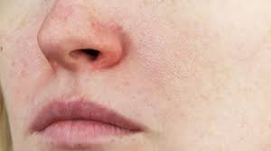 Jul 27, 2017 · use topical treatments that contain vitamin k. Facial Redness Veins Victorian Dermal Group