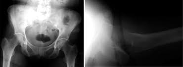 Apophyseal avulsion fractures are usually the result of a sudden forceful concentric or eccentric contraction of the muscle attached to the apophysis. Postoperative Iliac Crest Avulsion Fracture Cmaj