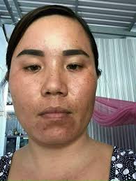 Em vao nhóm này cũng lâu, thấy mọi người nói damian hay qúa, không biết da  em bị thế này thì dinhf tầm mí hộp thì đẹp