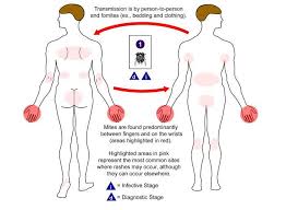 Image result for scabies transmission