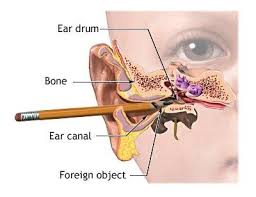 Clogged Ear How To Unclog Clogged Ears Are Common And Affect People Of Different Ages However C Blocked Ear Remedies Blocked Ears Home Remedies For Earache