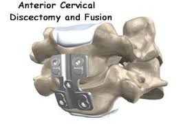 Single Level Vs Multilevel Acdfs 4 Important Outcome Trends Neck Surgery Cervical Spinal Surgery