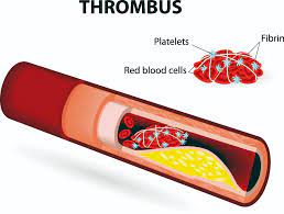 Association Between Mean Platelet Volume To Lymphocyte Ratio And The Presence Of Apical Mural Thrombus In Post Myocardial Infarction Patients International Journal Of Cardiovascular Sciences