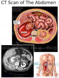 Sep 28, 2018 · how an abdominal ct scan is performed a typical abdominal ct scan takes from 10 to 30 minutes. Ct Scan Of The Abdomen Omega Pds