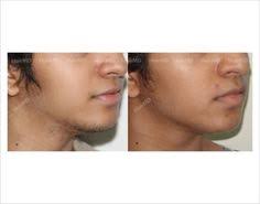 The laser is a concentrated beam of light that uses heat to destroy the follicle and helps delay future hair growth. 20 Best Laser Hair Removal Results Before And After Hairmd Pune Ideas Laser Hair Removal Results Laser Hair Removal Treatment Laser Hair Removal