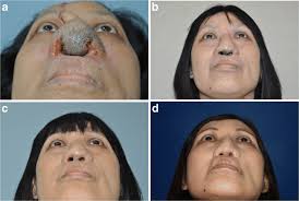 It's rare that we're unable to effectively remove hair during a treatment. Hair Removal Response Scores Following Laser Treatment A Poor Download Scientific Diagram