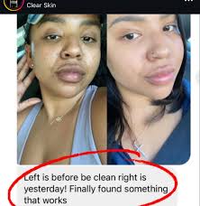 The BeClean effect is real! Making the bad skin good & the good skin great  ✨😎 #BeClean #ForMenAndWomen #BecomeNutrition #skin ✨Testimony page:  @becleaneffect ✨ Grab your bottle: @becomenutrition