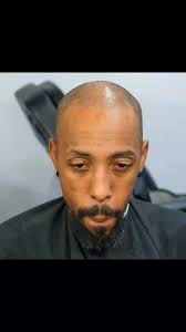 Allow us to solve your hair loss problems. #scalpmicropigmentationtex...