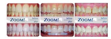 As with other whitening products, zoom is not recommended for children under 13 years of age, or for pregnant or lactating women. Philips Zoom Teeth Whitening Camden London Teeth Whitening Offers