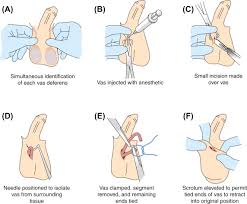 Recovery is variable and can take anywhere from 5 to 14 days. Vasectomy An Overview Sciencedirect Topics