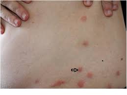 Alergia A Picada De Inseto Saiba O Que Causa E Como Tratar Prontopele