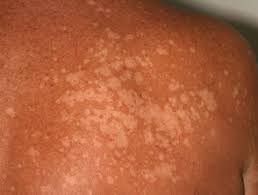 Pityriasis alba is a common skin disorder in children (90%) and young adults. Definiciones Dermatologia Archives Seite 38 Von 233 Dermatly Com El Sitio De Tu Piel