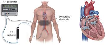 Image result for Radiofrequency Surgery