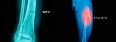 Diferencias Entre Fisura Y Fractura Canalsalud
