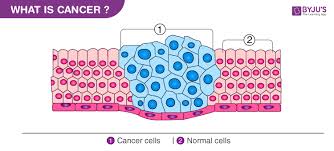 Characteristics needed for cancer cell formation. Cancer Types Causes Diagnosis And Treatment Of Cancer