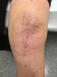 Often after any type of knee surgery, excess swelling occurs to protect the knee… but then scar tissue, and eventually fibrosis, can set in as rest increases. Atlanta Outpatient Orthopedic Joint Replacement For Knees Hips Atlanta Bone And Joint Specialists