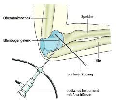 Ellenbogen der ellenbogen ist der nördlichste teil der nordfriesischen insel sylt. Ellenbogen Niels Stensen Kliniken
